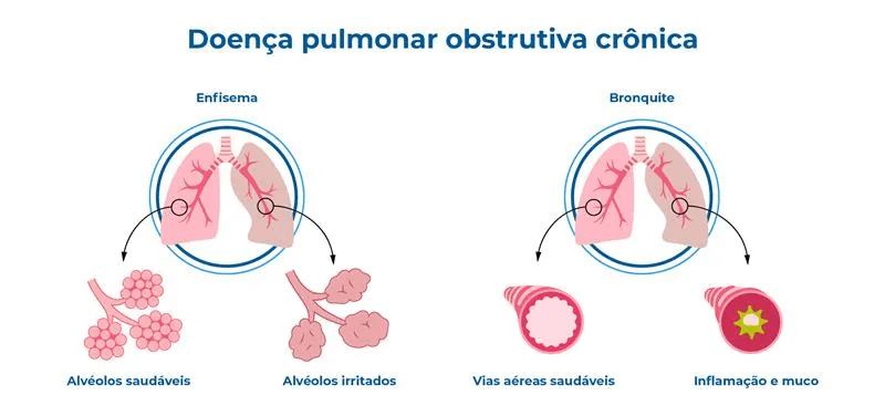 Doença pulmonar obstrutiva crônica